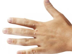 Uzmanlardan Siğil Uyarısı