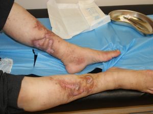 "Varis Hastalığının Belirtilerini Göz Ardı Etmeyin"