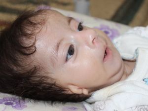 Kulakları Olmayan Bebek Ameliyat Olmayı Bekliyor