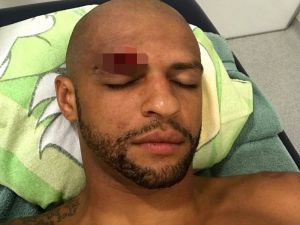 Melo’nun Kaşı Açıldı