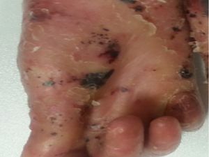 Bu Hastalığın Dünyada Tam Tedavisi Yok