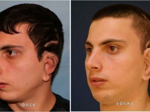 Annenin Kaburgasından Oğluna Kulak