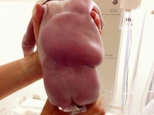 Anne Karnındaki Bebek Hayat Kurtadı