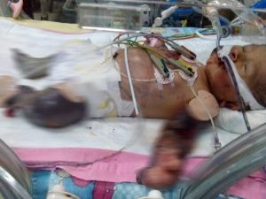 Vücudu Kuvözde Morarıp Şişmeye Başladı