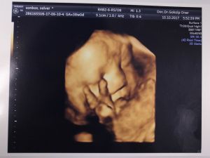 Anne Karnında Zafer İşareti