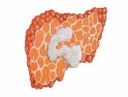 Her yıl 1 milyon kişi hepatitten ölüyor