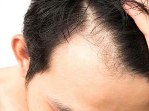 Şaşırtan İddia: Kelliği Bitiren İlaç Geliştirdi