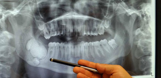 Diş ağrısının asıl sebebi bakın ne çıktı!