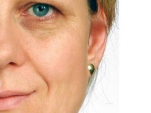 "Sarkık Göz Kapağı Sadece Estetik Sorun Değil"