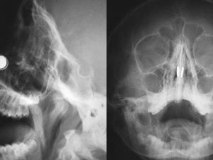 Türk Doktorlardan Literatüre Geçen Uygulama