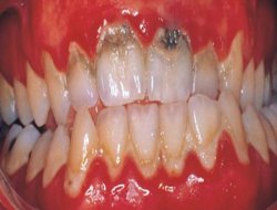 Diş iltihabı deyip geçmeyin