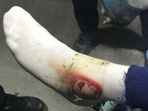 Fenerbahçe Hasan Ali Kaldırım’ın Ayağının Fotoğrafını Paylaştı.