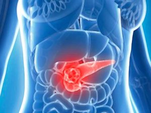 Kanserde Doğru Bilinen Yanlışlar