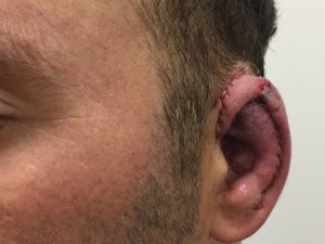 Kazada Kaybettiği Kulağından Yeni Kulak Yapıldı