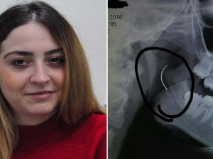 Boğazındaki İğneyle Tam 18 Yıl Yaşadı
