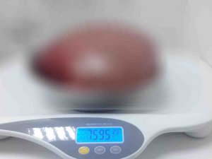 Karnından Çıktı: 7,5 Kilo Ağırlığında