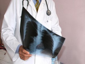 Kadınlarda akciğer kanseri oranı yükseldi