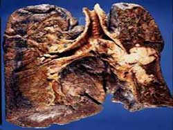 Çekirdek deyip geçmeyin! Kansere karşı birebir