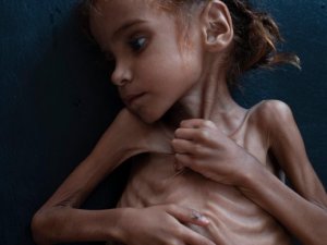 Yemen’de Kolera Salgını