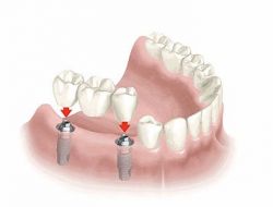 Diş Eti Kanamasını Önemseyin