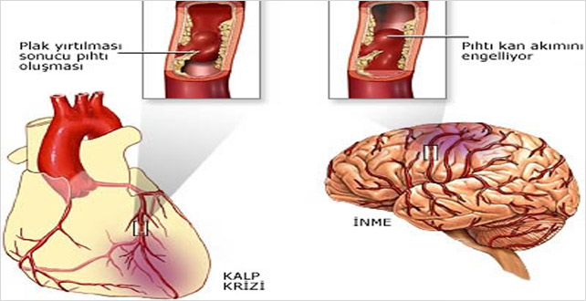 Kalp krizi riski hesaplanabiliyor