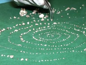 7 Yaşındaki Çocuğun Ağzından 526 Diş Çıkarıldı