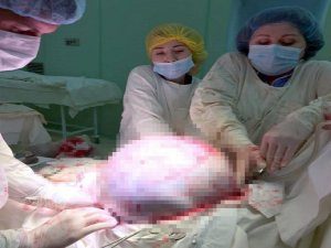Rusya’da Kadının Yumurtalıklarından 25 Kilogram Tümör Çıkarıldı