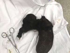 10 Yıl Boyunca Yediği Saçları Midesinden Çıkarıldı