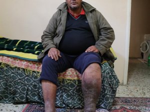 Varis Ameliyatı Oldu, Fil Hastası Çıktı