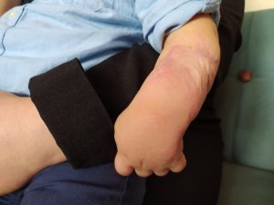Minik İsa’nın Kolundaki Yanık, Elini Kullanamaz Hale Getirdi