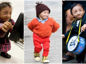 Dünyanın En Kısa Adamı 28 Yaşında Hayatını Kaybetti