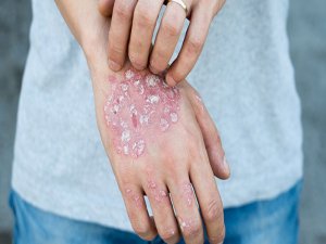 'Bazı bitkisel ilaçlar sedef hastalığını alevlendirebilir'