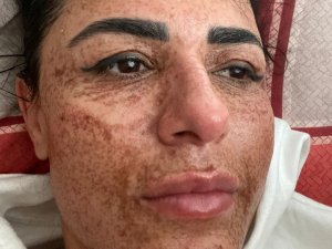Güzelleşmek İsterken Yüzünde Yanıklar Oluştu