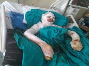 Bitlenen Saçlarını Benzinle Yıkamak İsterken Kendini Yakan Kız Yardım Eli Bekliyor
