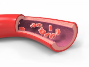 Damar Sertliği Olarak Bilinen Atardamarların Kalınlaşması Durumu Ateroskleroz