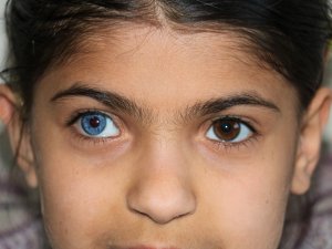 Yasin Ve Elif Kardeşler Hayata Çift Renk Bakıyor