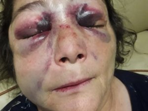 Kadını Döverek Bu Hale Getirdiler