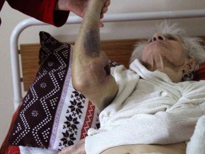 92 Yaşında Covid-19’u Yense De Vücudunda Oluşan Yaralar Tedirgin Etti