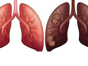 Akciğer Kanserine Yüzde 90 Tütün Kullanımı Neden Oluyor