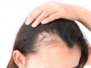 Saçınız Günde 100 Tel Dökülüyorsa Dikkat