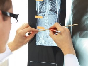 Ebeveynlerin Dikkati Çocuklarda Görülen Skolyozun Önüne Geçiyor