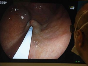 Mide Botoksunda 15 Dakikalık İşlemle Hastalar Rutin Yaşamlarına Devam Ediyor