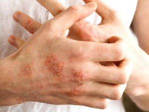 Soğuk Havalarda Egzamaya Dikkat