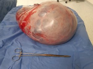 Karnından 9 Kilo Tümör Çıktı