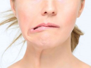 Soğuk Hava Yüz Felcini Arttırıyor