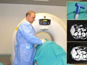 Karaciğer Kanseri Tedavisinde ‘Mikrodalga Ablasyon’ Yöntemi