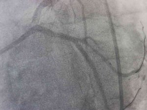 Dünyada Yılda 500 Bin İnsanın Ölümü Trans Yağlardan