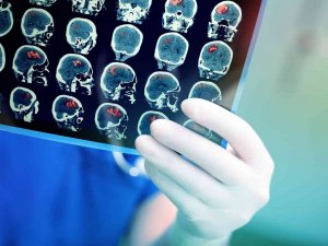 Yeni Cerrahi Teknolojiler Beyin Tümörü Ameliyatlarındaki Başarıyı Artırıyor