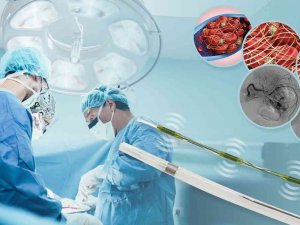 Derin Ven Trombozu Tedavisinde Yeni Dönem: Viper Ultrasonik Farmakomekanik Tromboliz Sistemi