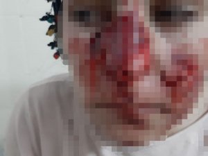 Mardin’de Sokak Köpeği Vahşeti: Vatandaşların Yüzleri Parçalandı